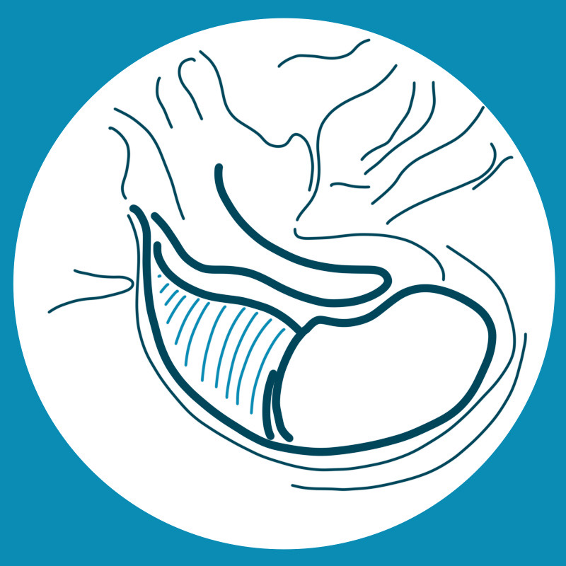 Paranganglioma - Gruppo Otologico